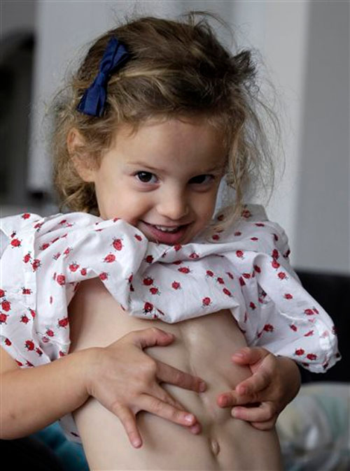 Alice de Pooter, 3, shows her surgery scar and the bulge from a pacemaker battery on Tuesday, October 20, 2015, in Tomball, Texas. Photo: AP
