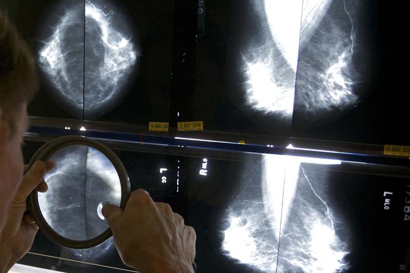 A radiologist uses a magnifying glass to check mammograms for breast cancer in Los Angeles, on May 6, 2010. Photo: AP/ File