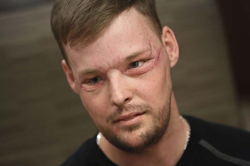 Face transplant recipient, Andy Sandness, attends a speech therapy appointment at Mayo Clinic in Rochester, Minnesota on January 24, 2017. Photo: AP