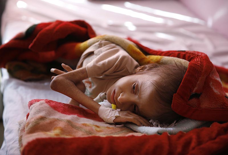 FILE -- In this Jan. 24, 2016 file photo, a malnourished child lies in a bed waiting to receive treatment at a therapeutic feeding center in a hospital in Sanaa, Yemen. Photo: AP