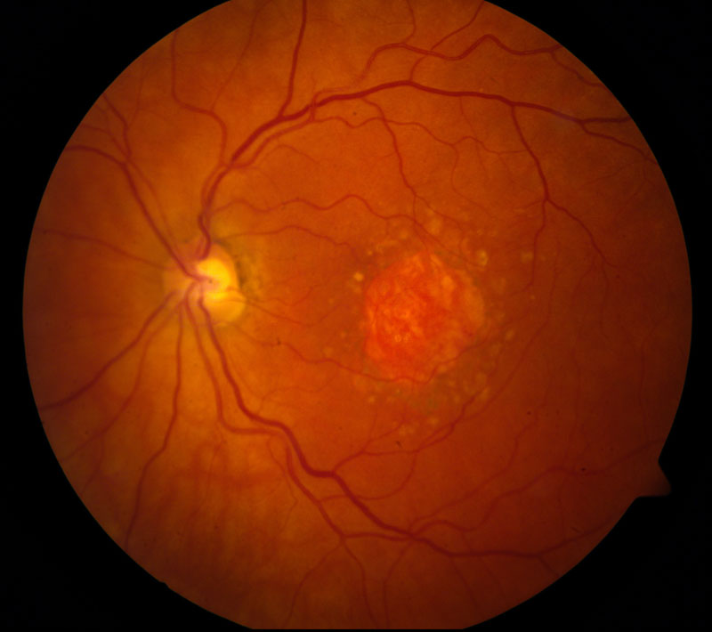 This image provided by the National Eye Institute shows a microscopic image of a retina being damaged by the so-called 'dry' form of age-related macular degeneration. Photo: AP