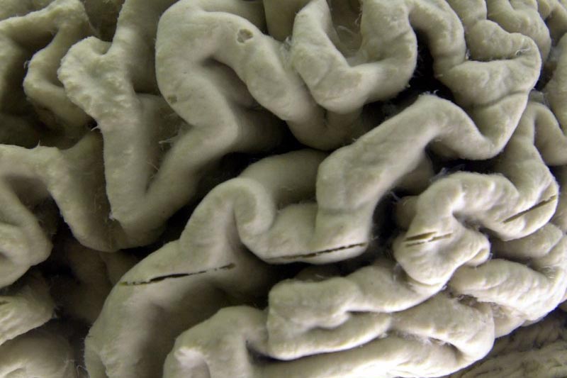 A section of a human brain with Alzheimeru2019s disease is on display at the Museum of Neuroanatomy at the University at Buffalo, in Buffalo, New York, on October 7, 2003. Photo: AP/ File