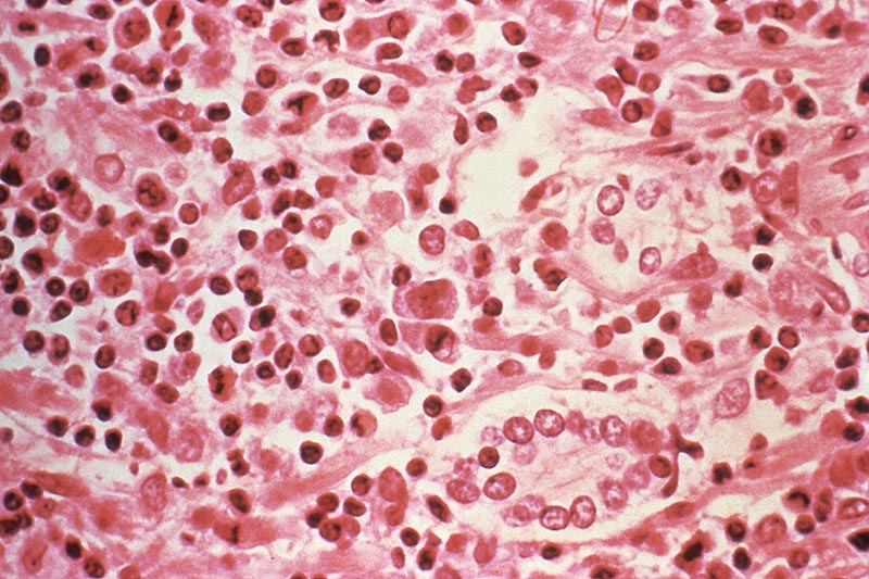 A micrographic study of liver tissue seen from a Hantavirus pulmonary syndrome (HPS) patient seen in this undated photo obtained by Reuters, July 6, 2017. Photo: CDC/Handout via Reuters