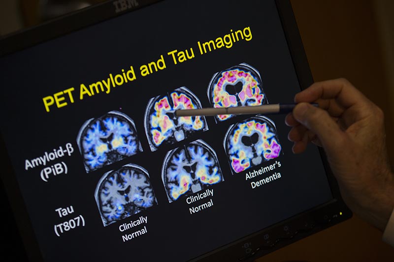 R Scott Turner, Professor of Neurology and Director of the Memory Disorder Center at Georgetown University Hospital, points to PET scan results that are part of a study on Alzheimer's disease at Georgetown University Hospital in Washington, in May 19, 2015. Photo: AP