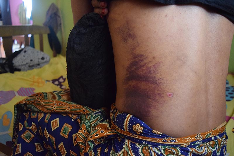 A Malaysian transgender woman who suffered physical assault shows injuries on her back during an interview in Rantau, Malaysia, on August 20, 2018. Photo: Thomson Reuters Foundation