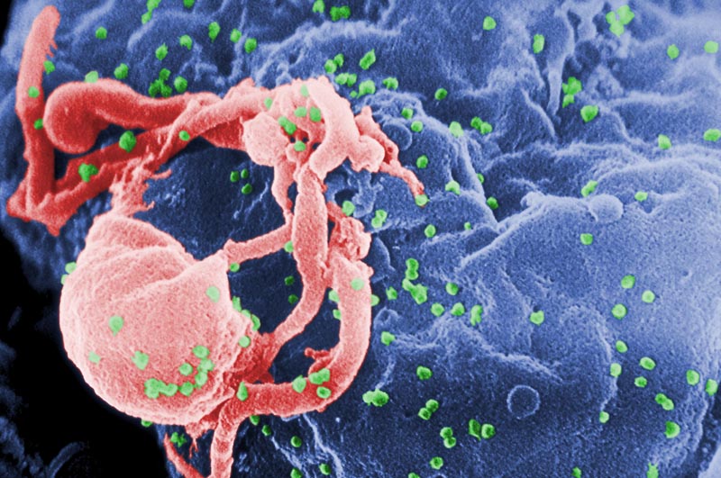 This scanning electron microscopic (SEM) image shows the presence of numerous human immunodeficiency virus-1 (HIV-1) virions (spherical in appearance) budding from a cultured human lymphocytes in this 1989 image obtained from Centres for Disease Control and Prevention (CDC) in Atlanta, Georgia, US on March 5, 2019. Photo: Courtesy C. Goldsmith, P. Feorino, E. L. Palmer, W. R. McManus/CDC/Handout via Reuters