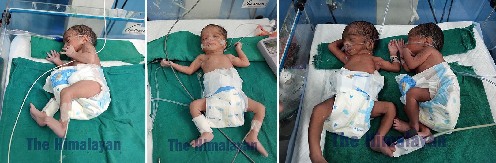 This combo image shows quadruplets delivered through caesarean section, at Manipal Teaching Hospital, in Pokhara, Kaski district, on January 16, 2020. Photo: Bharat Koirala/THT