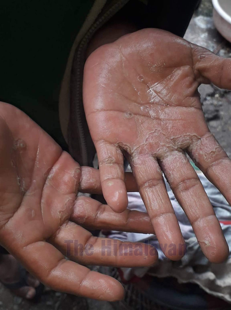 An image of the hands of a minor rescued from a restaurant few months ago, in Pokhara. Photo: Bharat Koirala / THT