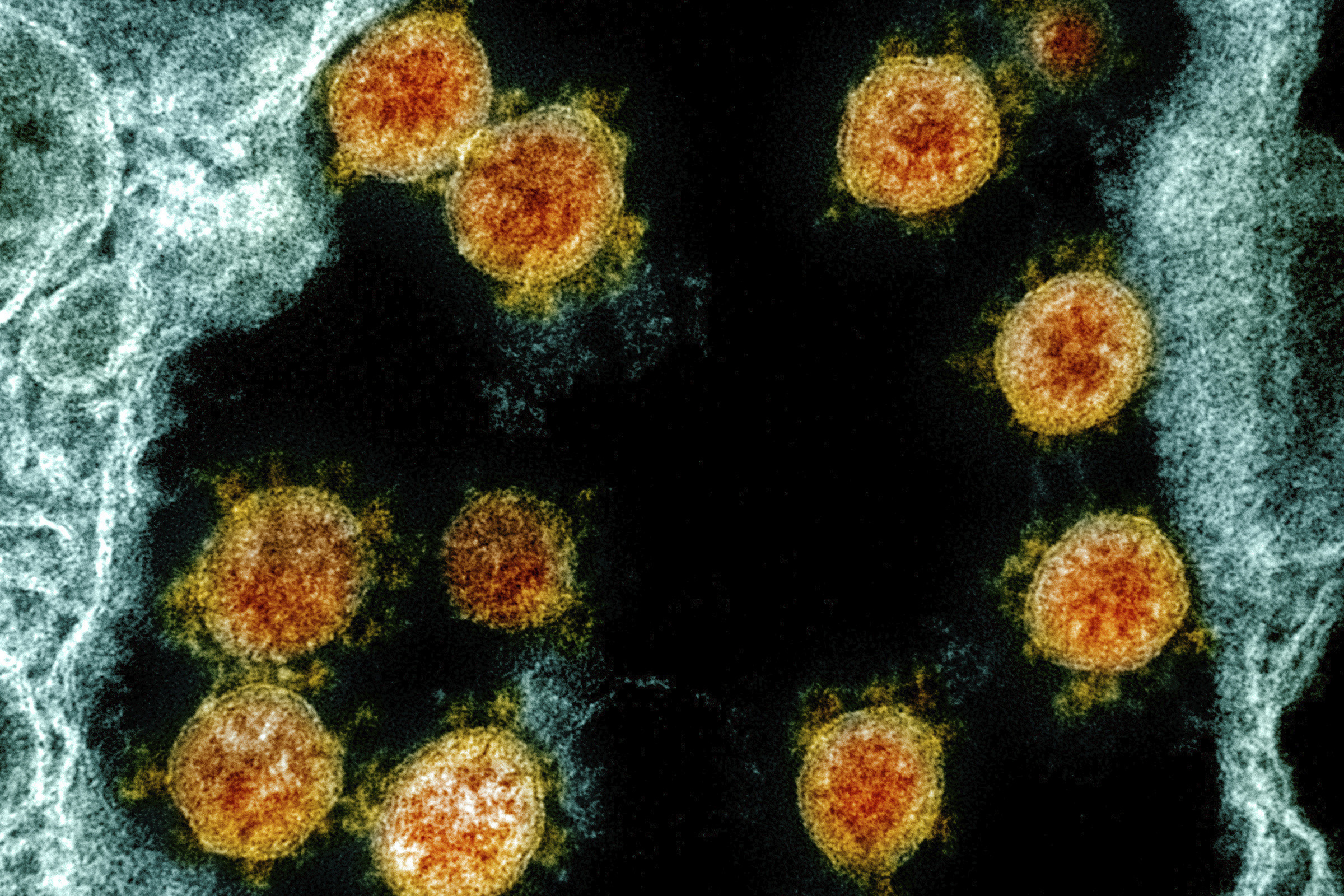 This electron microscope image made available and color-enhanced by the National Institute of Allergy and Infectious Diseases Integrated Research Facility in Fort Detrick, Md., shows Novel Coronavirus SARS-CoV-2 virus particles, orange, isolated from a patient. Research released on Thursday, May 28, 2020 shows how dangerous the coronavirus is for current and former cancer patients. Those who developed COVID-19 were much more likely to die within a month than people without cancer who got it, two studies found. Photo: NIAID/National Institutes of Health via AP