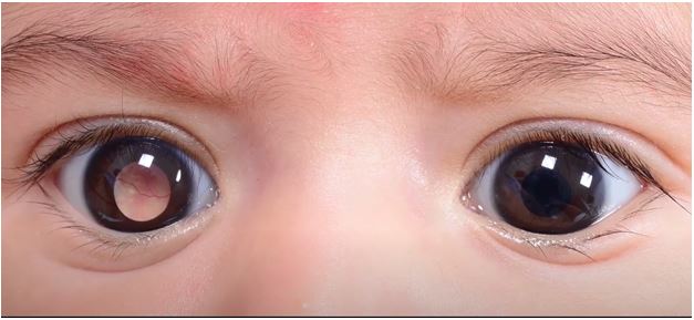 Retinoblastoma patient with white pupil right eye. Photo Courtesy: Rohit Saiju